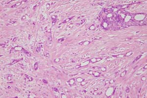Medium power view of >75% tubule formation